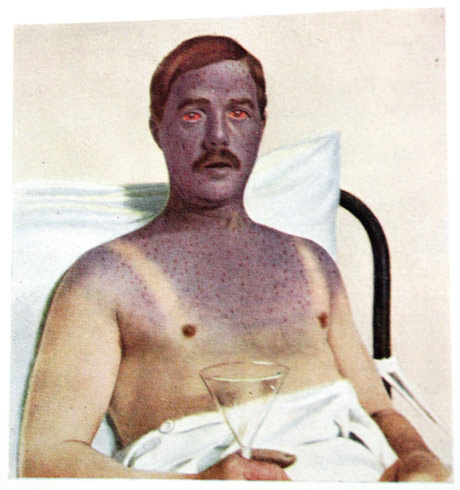 Chap with a moustache, not well at all in a hospital bed